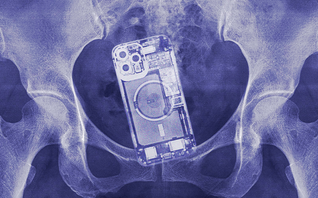 加拿大结直肠癌协会：惊！检查出结肠里藏了部iPhone