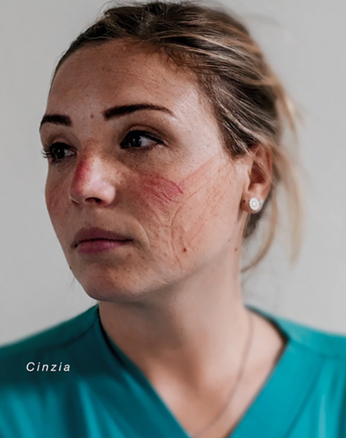 英国多芬医护人员的满脸勒痕别样美